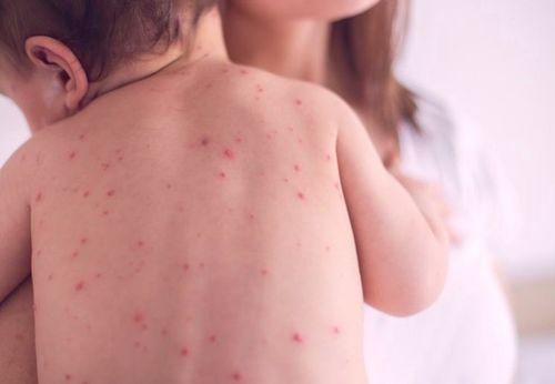 Орост улаанбурхан өвчин дэгджээ