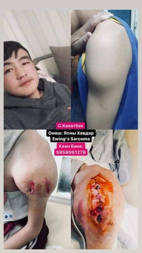 Ясны хавдартай хүү тусгай үүргийн онгоцоор Турк руу нисэхийг хүсч байна
