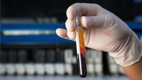 Шинжлэх ухааны хувьсгал: Англид хавдрыг нэн эрт оношлох тест туршиж эхлэв